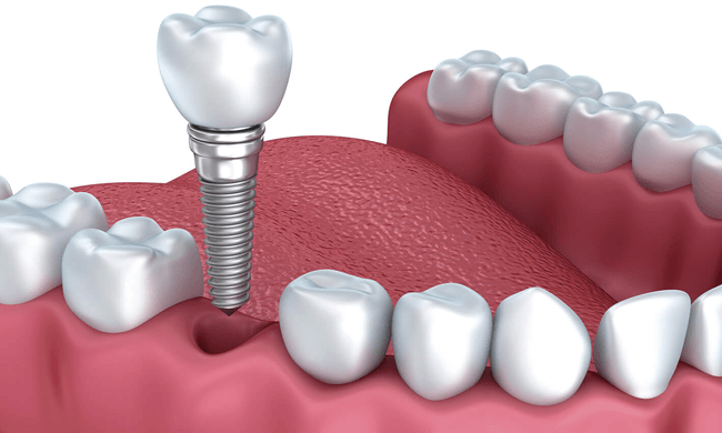 Cấy ghép nha khoa (Dental Implant)